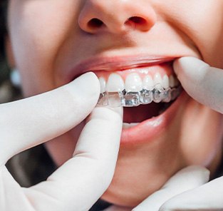 Dentist putting clear aligner on patient