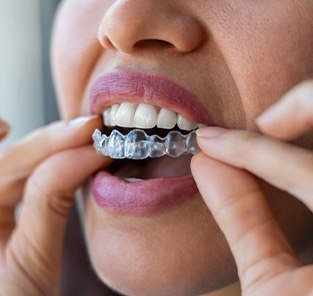Closeup of patient putting on clear aligners