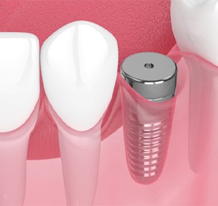 Digital illustration of a dental implant in Norton Shores