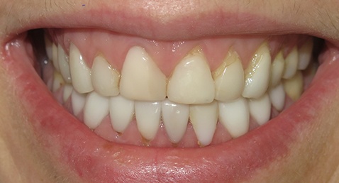 Smile with discolored top teeth
