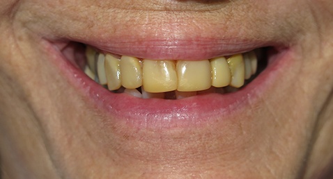 Dark yellow top teeth