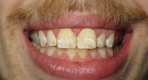 teeth that have build-up over them