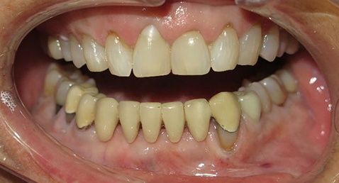 Damaged and yellow teeth before smile makeover