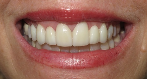 Bright smile after cosmetic dentistry