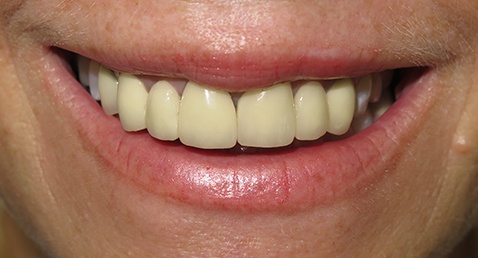Yellow smile before cosmetic dentistry