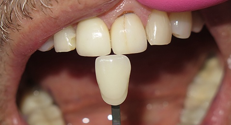 Damaged smile compared with dental restoration color chart