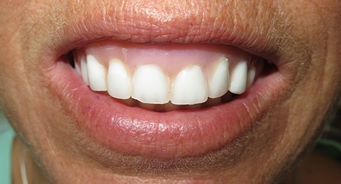Gummy smile before cosmetic dentistry