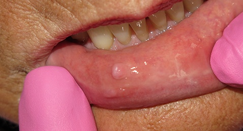 Closeup of patient with soft tissue sores