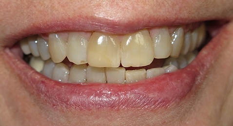 Yellowed smile before dental treatment