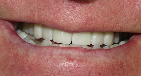 Perfected smile after full mouth reconstruction