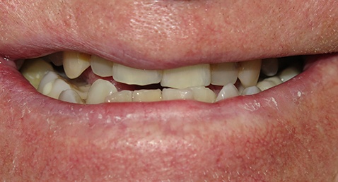 Worn damaged teeth before full mouth reconstruction