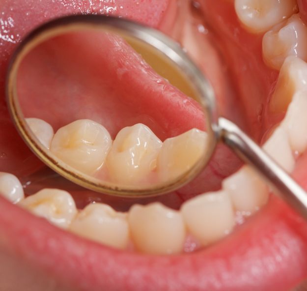 Dentist examining smile after placing metal free dental restoration