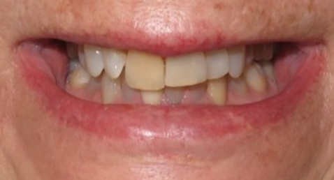 crown 9 before