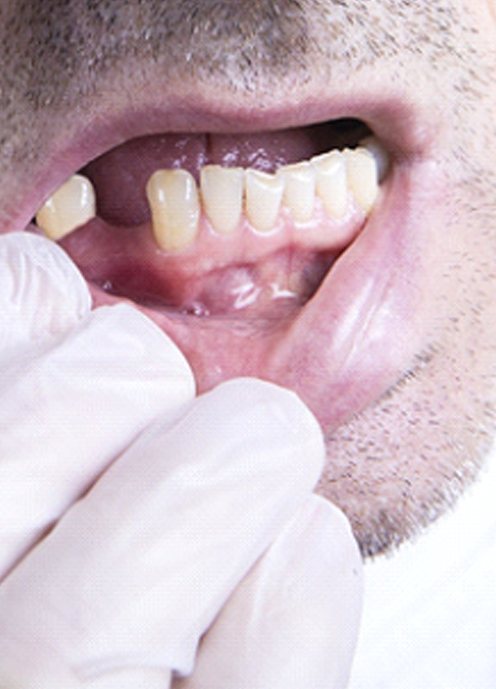 Man with missing tooth needing dental bridge in Norton Shores