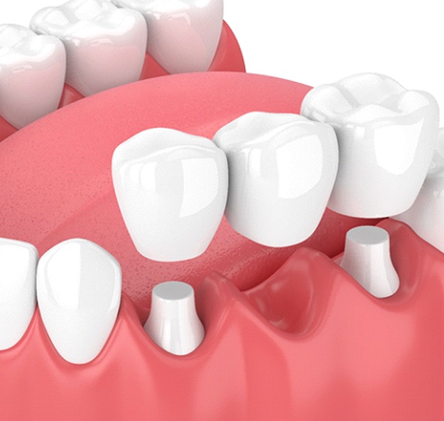 Digital model of a dental bridge