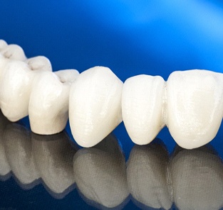 All-ceramic dental bridge