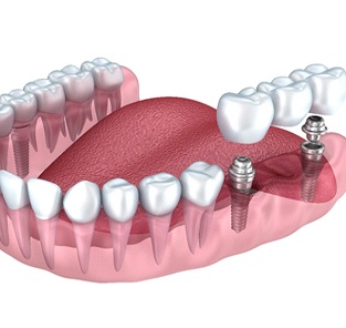 Image of an implant supported bridge