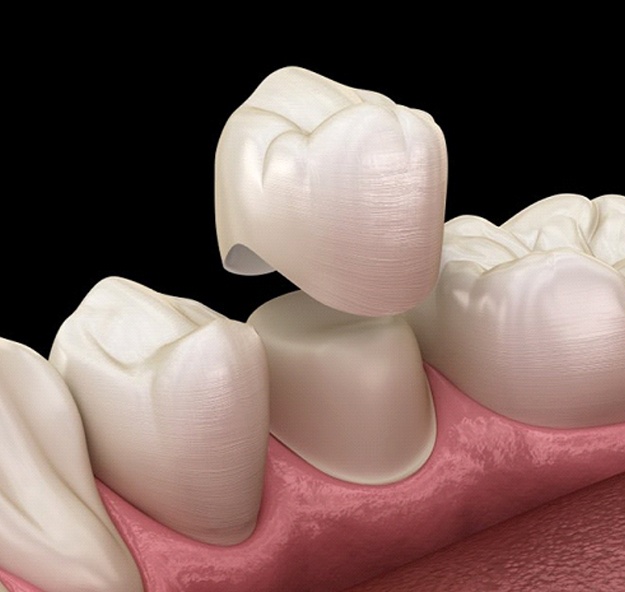 dental crown being fitted over a tooth