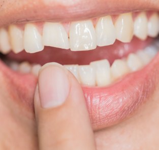 Closeup of smile with chipped front tooth