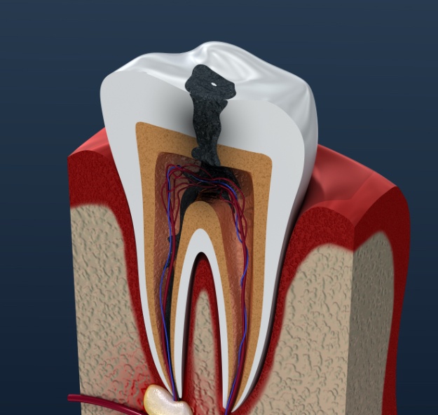 Animated tooth with damage in need of root canal therapy