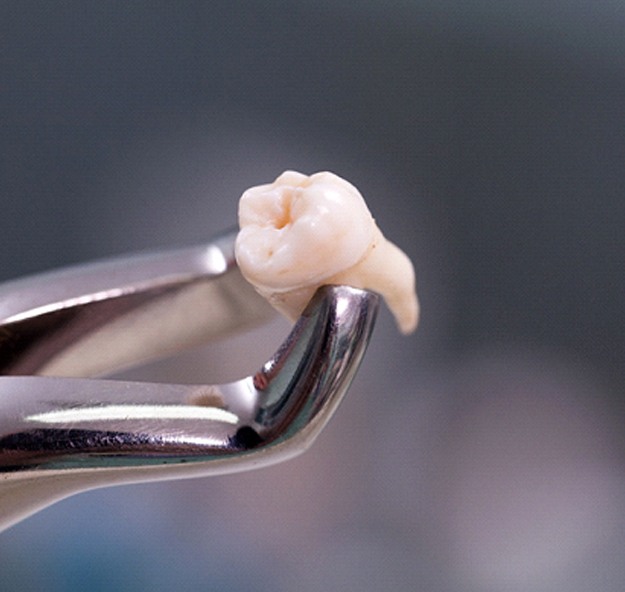 Clamp holding tooth after tooth extraction in Norton Shores