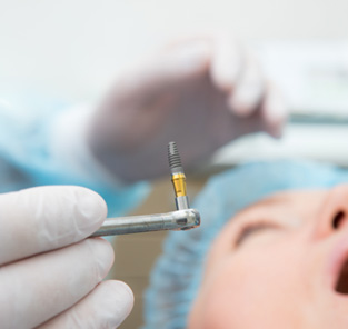 Closeup of dental implant before it’s placed in patient’s jaw
