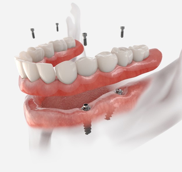 Side-view of implant denture for lower arch being screwed into place