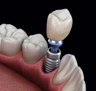 Animated dental implant supported dental crown placement