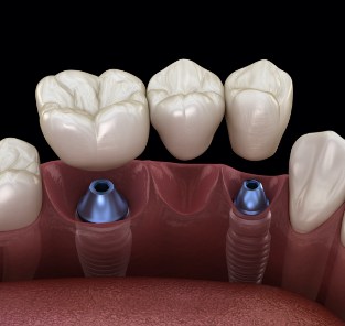 Animated dental implant supported fixed bridge placement