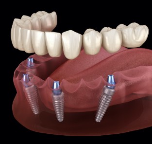 Animated dental implant supported denture placement