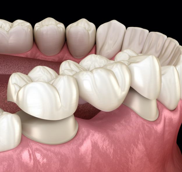 Animated smile during dental bridge placement