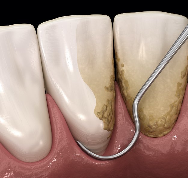 Animated smile during scaling and root planing treatment