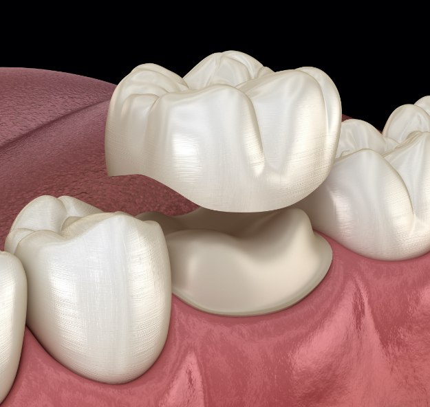 Animated smile with dental crown restoration