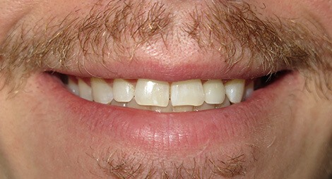 veneers 1 after