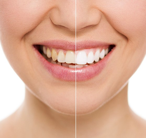 Nose-to-neck closeup of woman smiling with teeth half whitened to show before/after