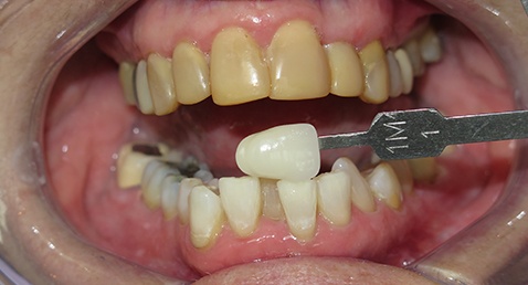 whitening 2 after