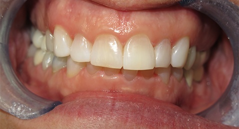 whitening 3 after