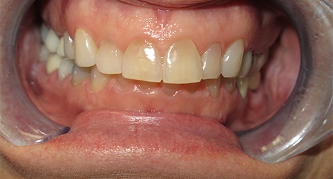 whitening 3 before