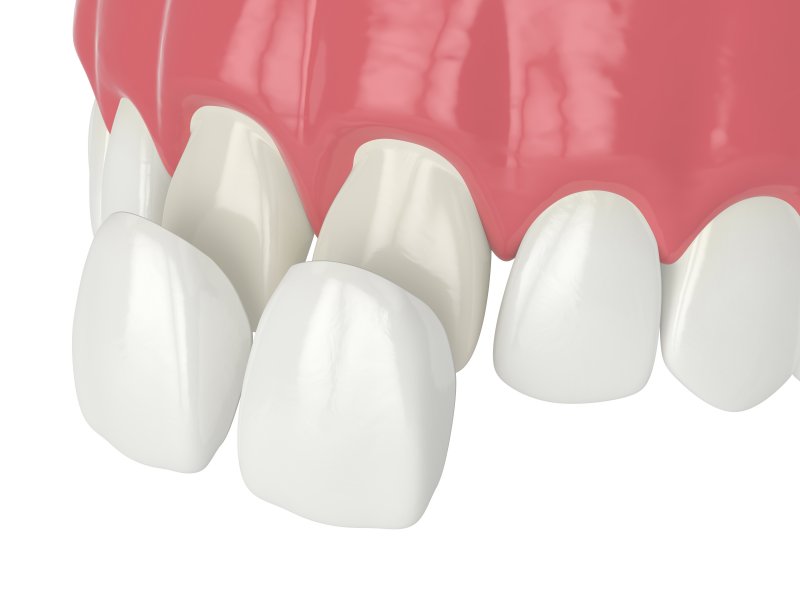 3D illustration of veneers from Norton Shores