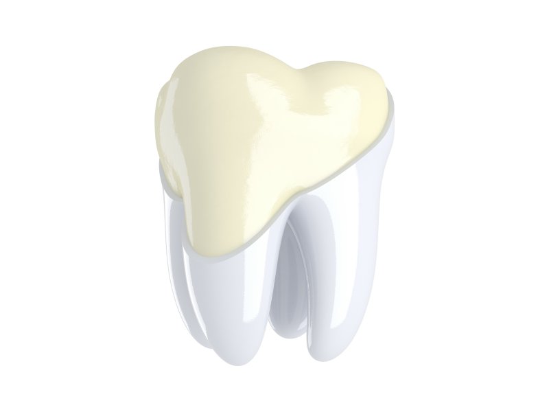 3-d model of a tooth with thinning enamel