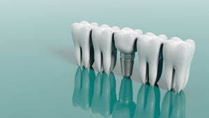 Model of dental implant standing in a row with natural teeth