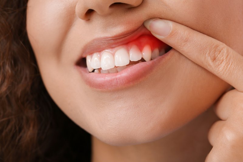 Woman holding up her upper lip to reveal reddened gums