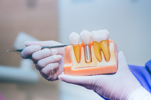 Dentist showing off dental implants