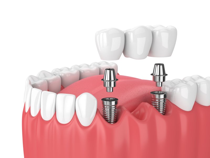 Model of a implant-supported bridge