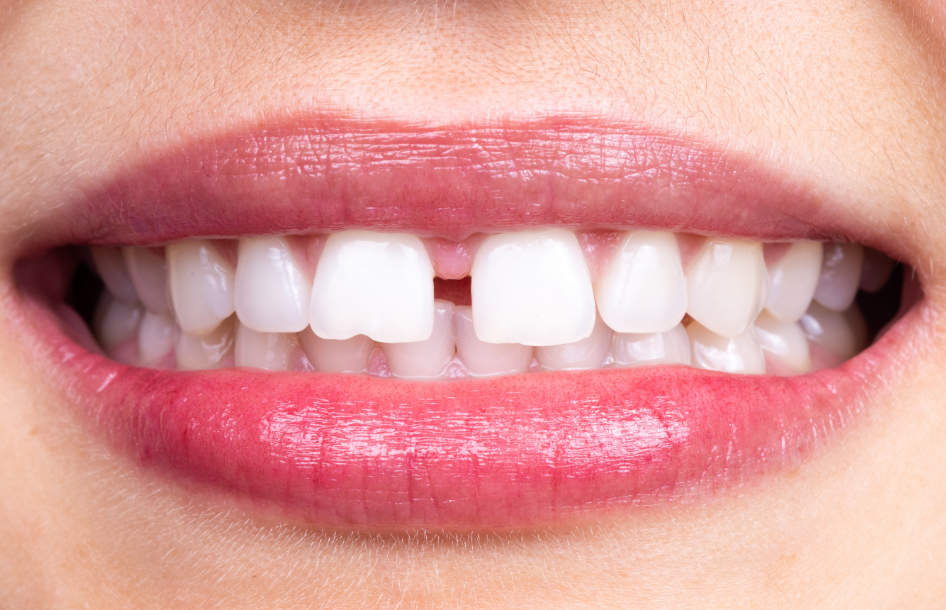 Woman's smile with tooth gap