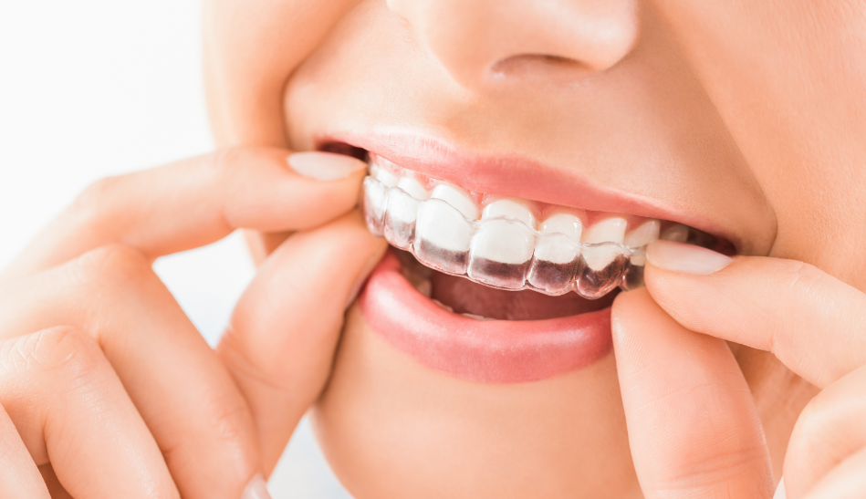 Close up of clear aligner on smiling mouth